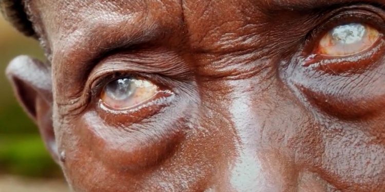 Niger Becomes First African Country to Eliminate River Blindness