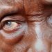 Niger Becomes First African Country to Eliminate River Blindness