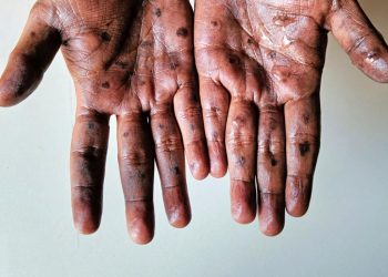 Kenya Confirms Two New Mpox Cases