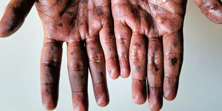 Kenya Confirms Two New Mpox Cases