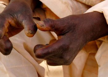 Nigeria to Receive Long-Awaited Leprosy Drugs After Year-Long Delay