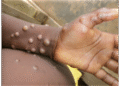 WHO Declares Mpox Outbreak Still a Global Health Emergency
