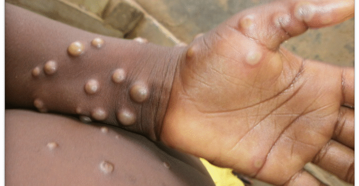 WHO Declares Mpox Outbreak Still a Global Health Emergency